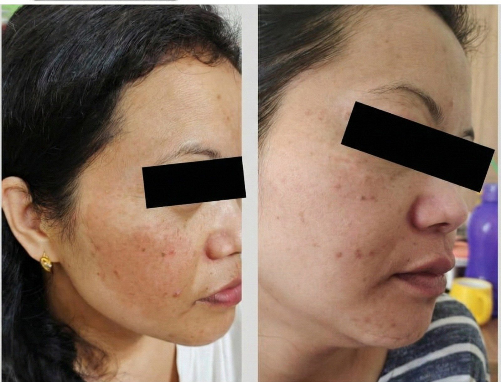 Before and after treatment: Melasma & pigmentation